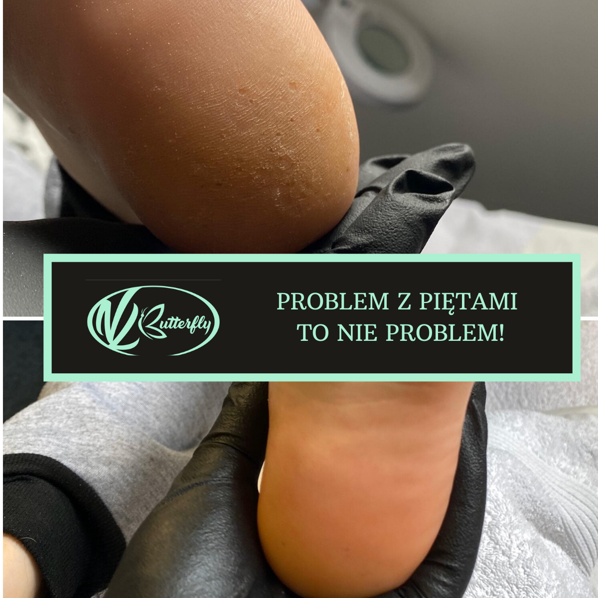 Read more about the article Problem z piętami to nie problem!