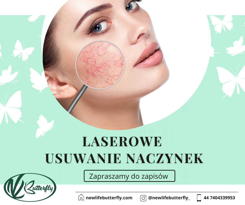 Read more about the article Laserowe usuwanie naczynek