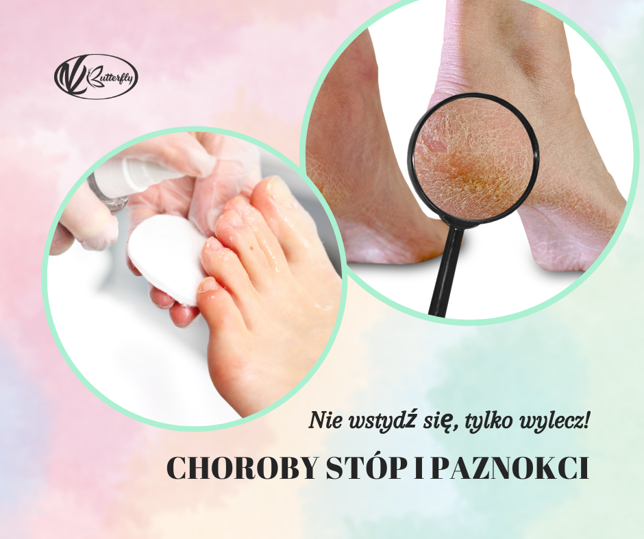 Read more about the article Nie wstydź się tylko wylecz – Choroby stóp i paznokci