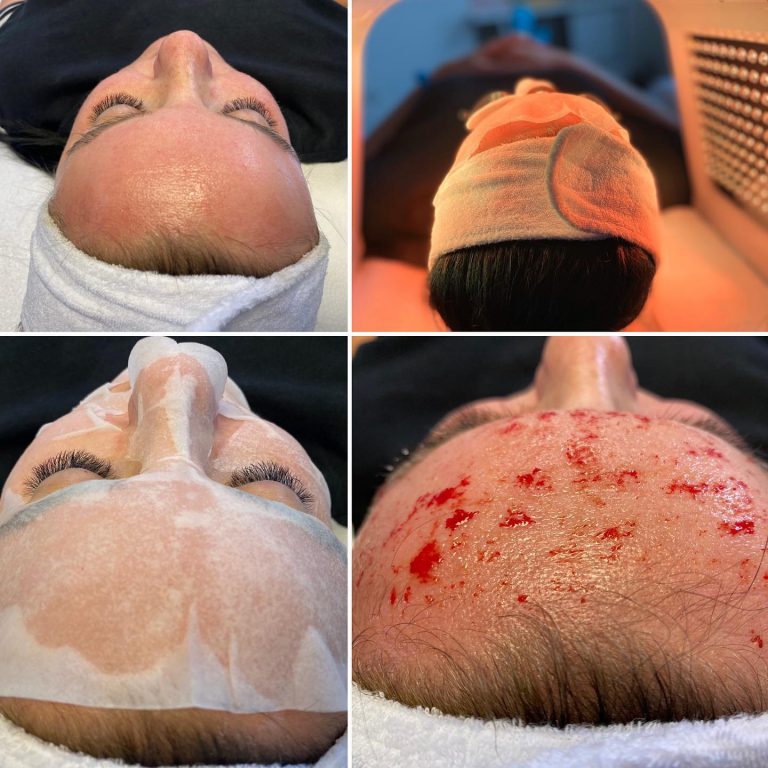 face treatment with needles
