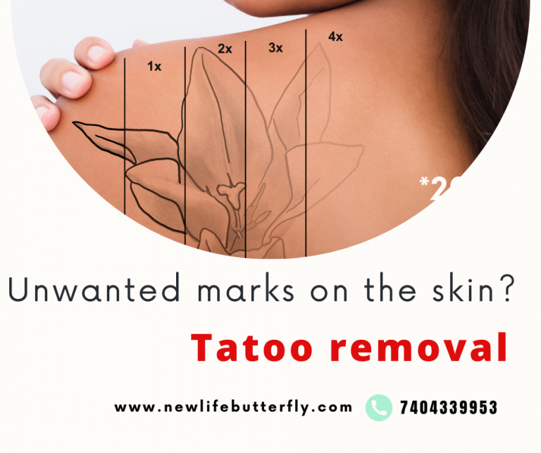 tatoo removal featherstone