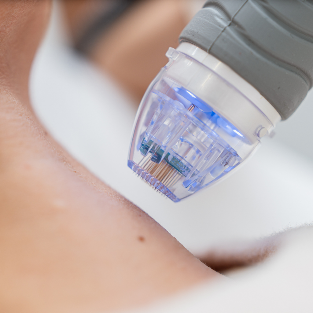 radiofrekwencja mikroigłowa rf wakefield