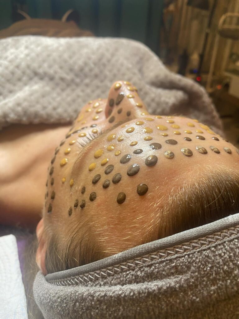 mezoterapia bb glow wakefield